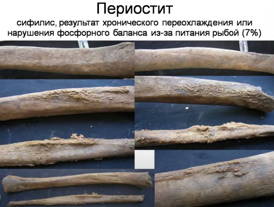 Патологии костей ног гребцов