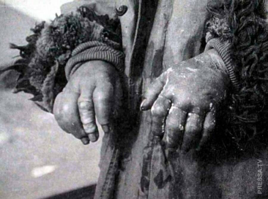 Отмороженные руки китайского пленного