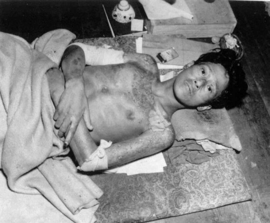 Молодой человек, пострадавший после взрыва второй атомной бомбы, в городе Нагасаки